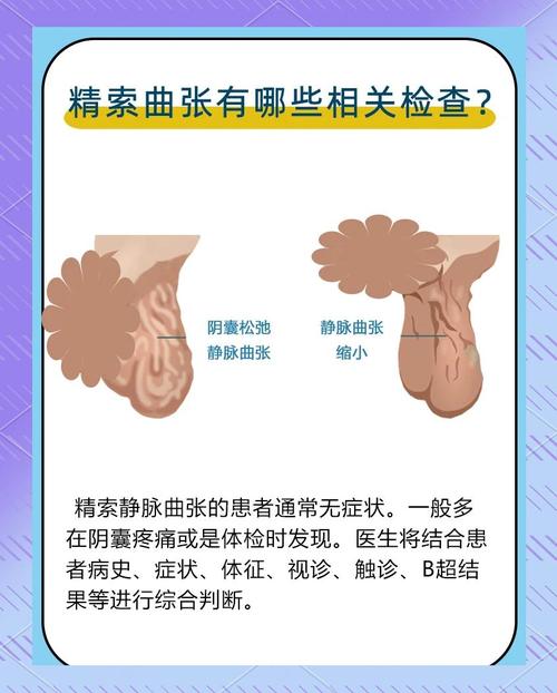 精索静脉曲张自查，摸到什么算异常