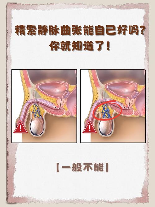 精索静脉曲张自查，摸到什么算异常