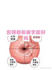 宫颈病变治疗会改变宫颈形态吗-两性知识丨两性健康--你想了解的我都知道
