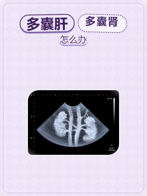 多囊需要长期随访吗
