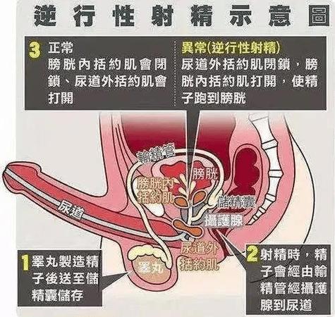 逆行射精是怎么回事，精液去哪了