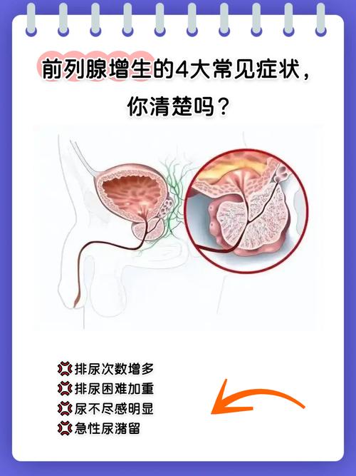 中年夜尿多、尿不尽，是前列腺增生吗