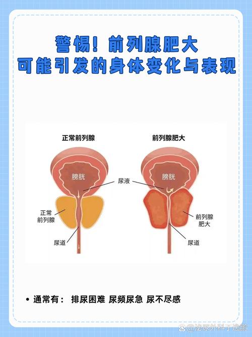 中年夜尿多、尿不尽，是前列腺增生吗