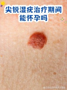 尖锐湿疣治疗期间能备孕吗?-两性知识丨两性健康--你想了解的我都知道