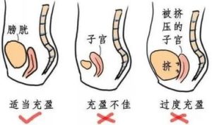 男性做前列腺B超要憋尿吗?一文给你讲明白!-两性知识丨两性健康--你想了解的我都知道