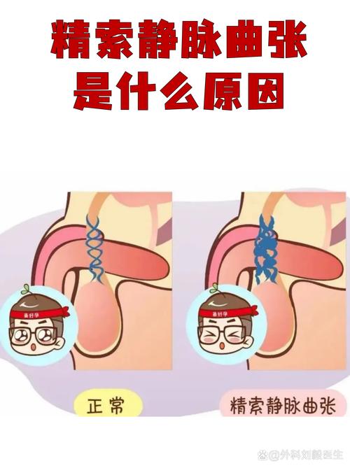 精索静脉曲张和碎片率的关系