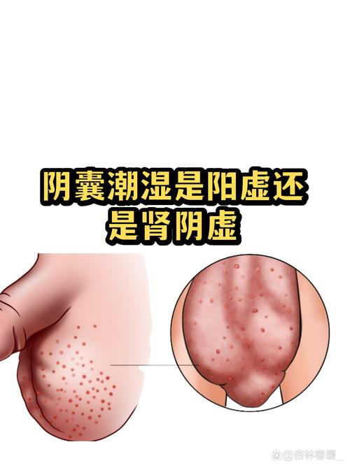 阴囊潮湿是病还是体质问题-相关配图