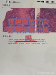 放疗对卵巢功能的影响有多大？-两性知识丨两性健康--你想了解的我都知道