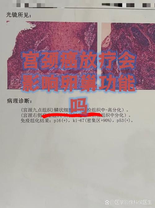 放疗对卵巢功能的影响有多大