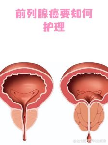 主动监测适合哪类前列腺癌？兔哥带你一文读懂！-两性知识丨两性健康--你想了解的我都知道