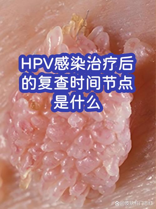 双方都感染HPV该怎么安排复查