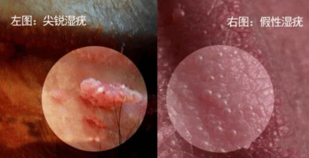 外阴长小疙瘩是炎症还是感染
