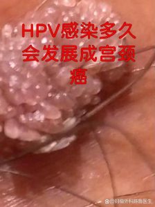 HPV持续感染多久会发展成宫颈癌？-两性知识丨两性健康--你想了解的我都知道
