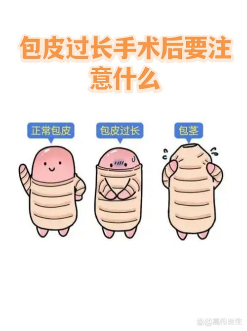 包皮手术后护理要注意什么