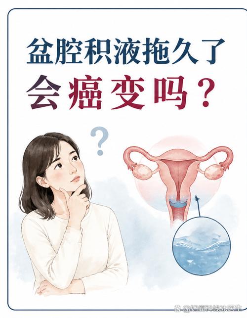 盆腔积液会变成癌症吗