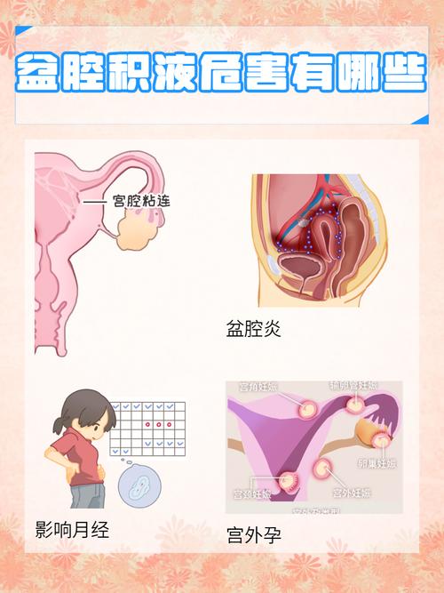 盆腔积液会变成癌症吗
