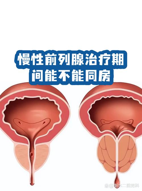 慢性前列腺炎治疗期间能同房吗