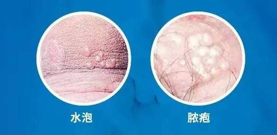 生殖器疱疹会终身携带吗