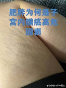 肥胖为什么会把子宫内膜癌风险推高?-两性知识丨两性健康--你想了解的我都知道
