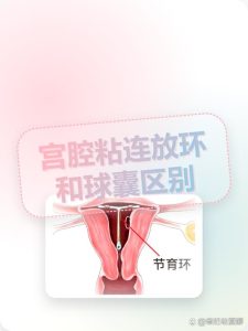 球囊和节育环防粘连哪个好?-两性知识丨两性健康--你想了解的我都知道