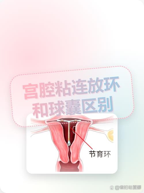 球囊和节育环防粘连哪个好