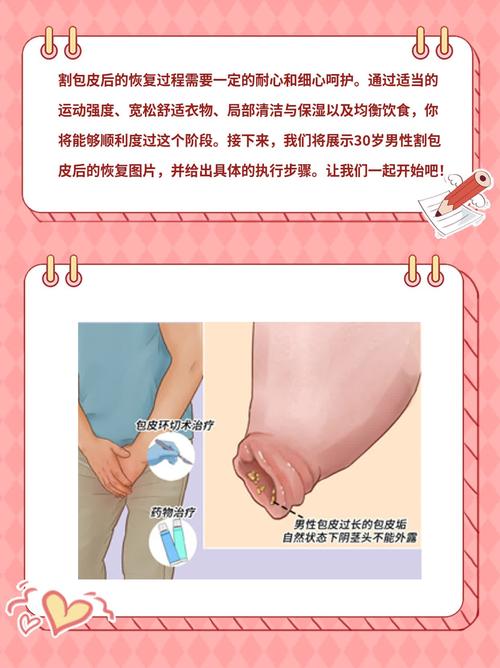 包皮环切后恢复期该注意哪些细节-示意图