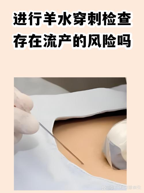 羊水穿刺有流产风险吗
