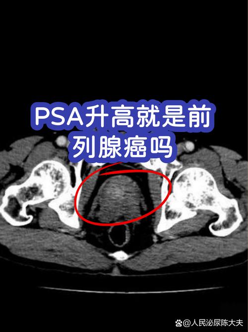 体检PSA偏高就是前列腺癌吗