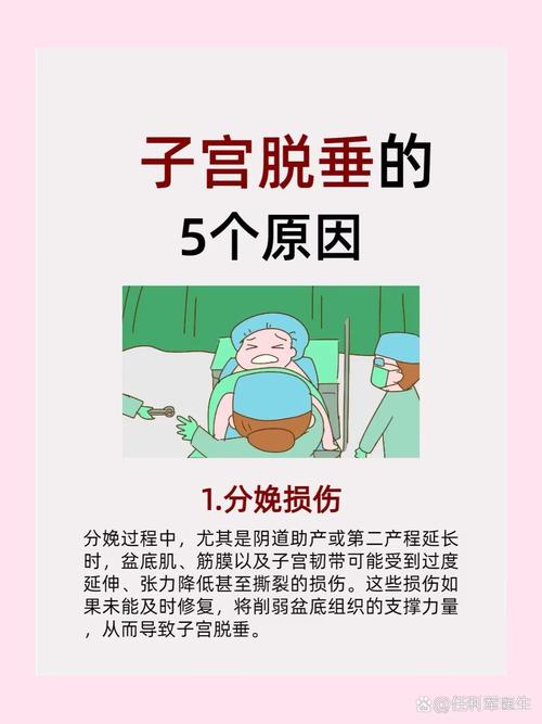 子宫脱垂能顺产吗