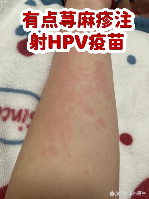 过敏体质能打HPV疫苗吗-相关配图