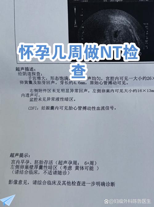 NT检查在孕几周做最合适