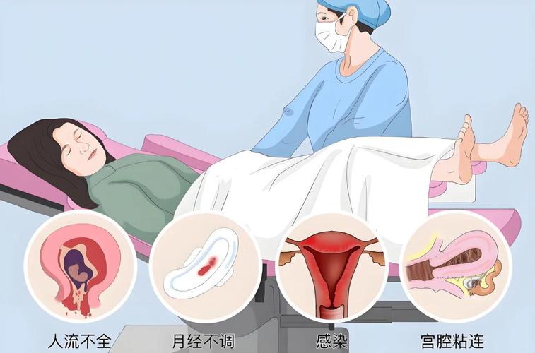 宫腔粘连和反复流产有关吗