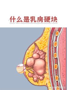 乳房摸到硬块要紧吗?一文帮你理清思路-两性知识丨两性健康--你想了解的我都知道