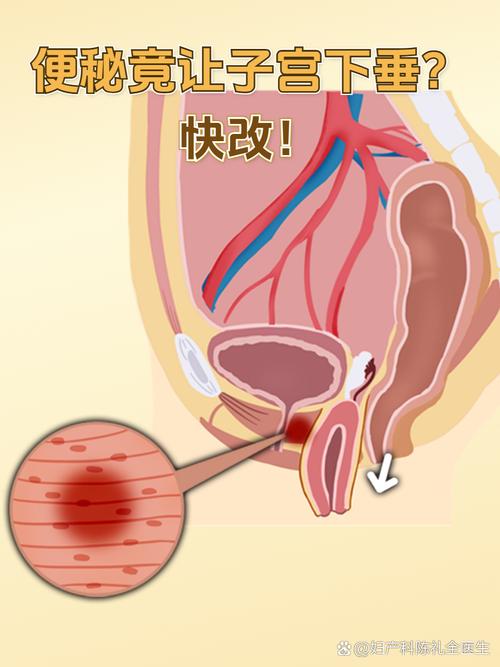 排便用力会让子宫下垂吗