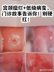 低级别宫颈病变的保刀抉择，多数情况先不动-两性知识丨两性健康--你想了解的我都知道