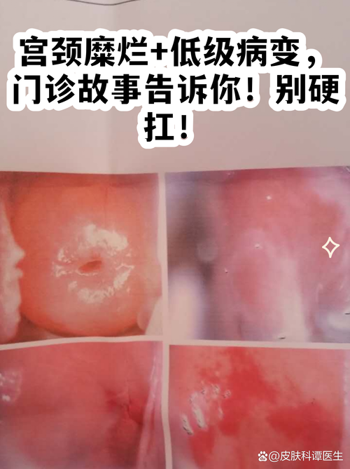低级别宫颈病变要不要动刀-示意图