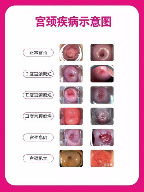 低级别宫颈病变要不要动刀-相关配图