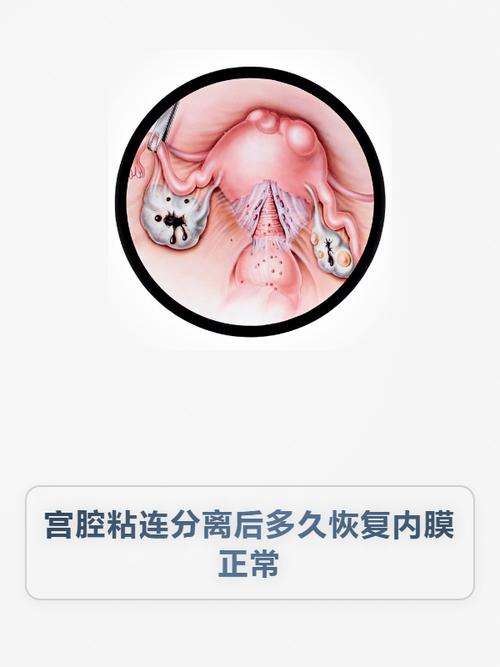 宫腔镜分离术后怎么促进内膜生长