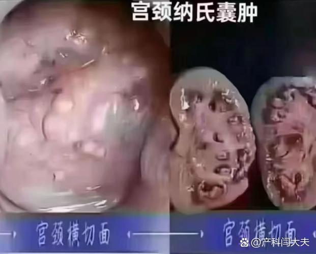 宫颈纳氏囊肿要处理吗