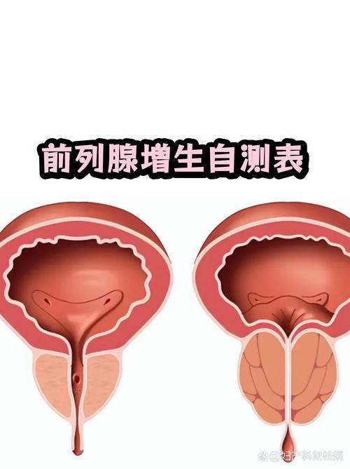 尿线变细就是前列腺增生吗