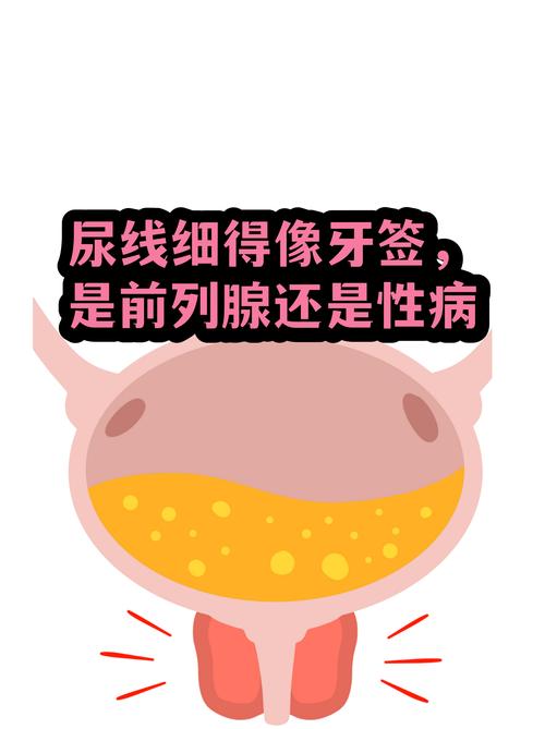尿线变细就是前列腺增生吗