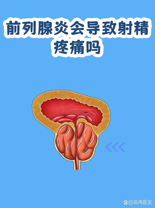 频繁射精会引起前列腺炎吗
