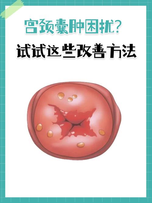 宫颈纳氏囊肿会自己消失吗