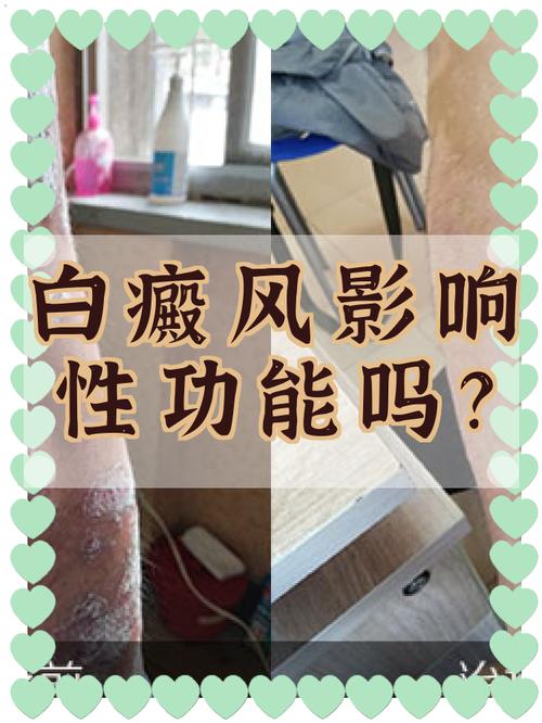 性欲低和白癜风有关吗
