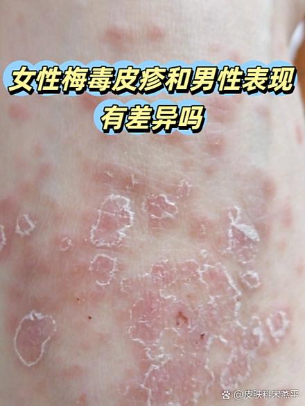 性欲低和梅毒病史有关吗