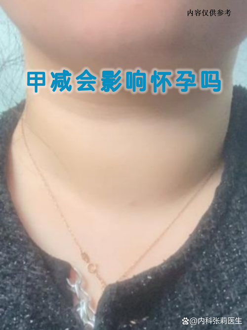 甲减没控制好会影响怀孕吗-相关配图