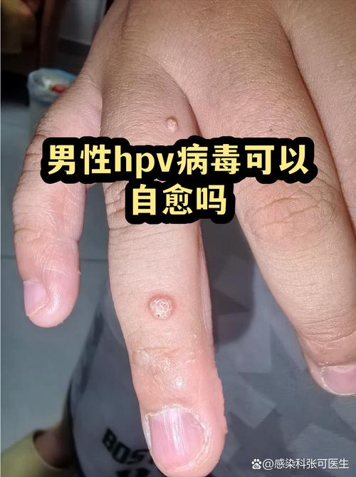 性欲低和HPV感染焦虑有关吗