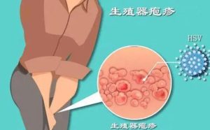 生殖器疱疹复发前,身体会发出哪些预警信号?-两性知识丨两性健康--你想了解的我都知道