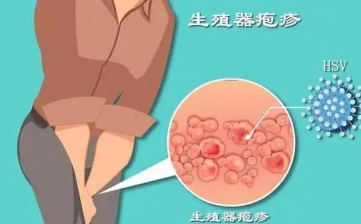生殖器疱疹复发前有什么信号