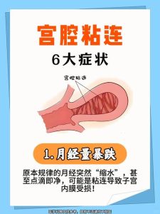 宫腔粘连有哪些症状-两性知识丨两性健康--你想了解的我都知道